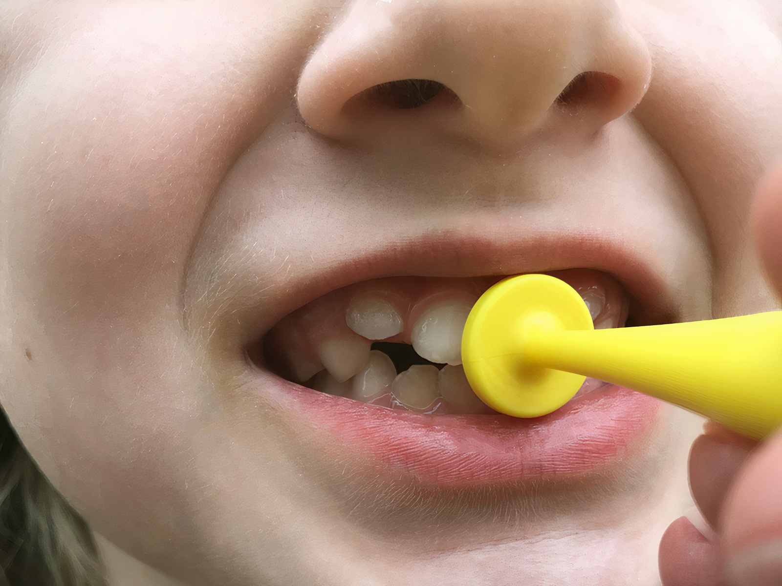 proButton - für Lippenverschluss/Stärke (2er Set)